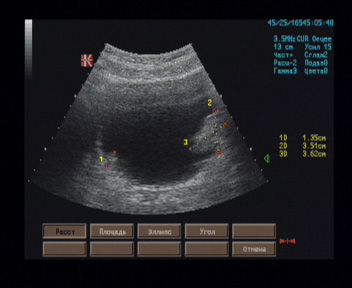 Эхографические признаки новообразования мочевого пузыря.