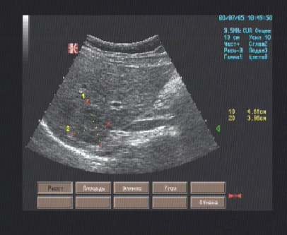 Эхографические признаки очага правой доли печени.