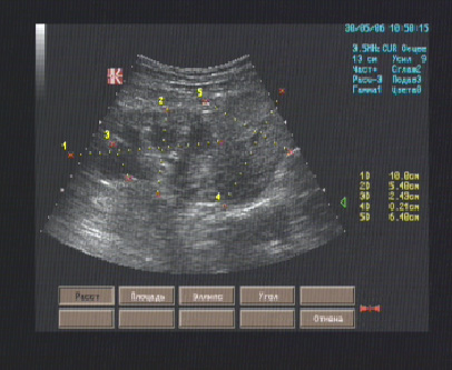 Эхографические признаки новообразования правой почки, гидронефроз правой почки, гидрокаликоз левой почки