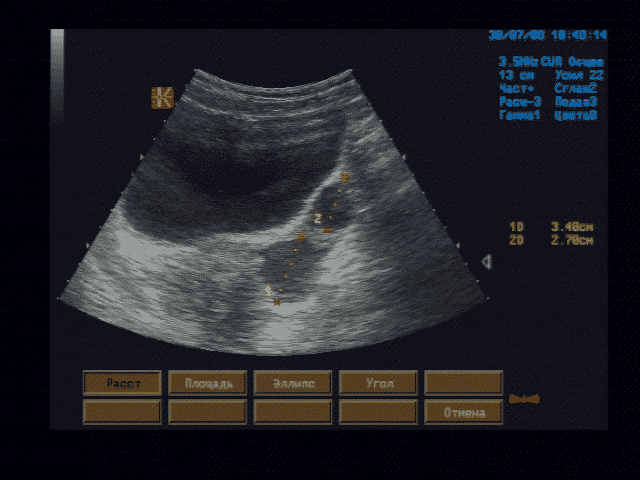 Эхографические признаки кист левого яичника, левостороннего гидросальпингса. Состояние после частичной резекции правого яичника.