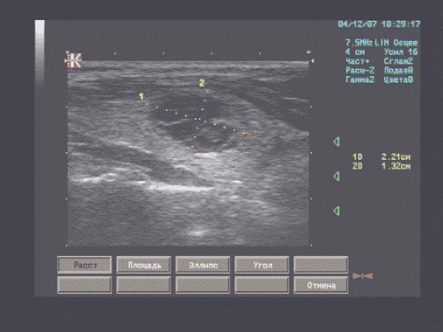 Эхографические признаки узлового образования смешанного строения (по эхоструктуре кистозно трансформированная аденома) правой доли щитовидной железы.