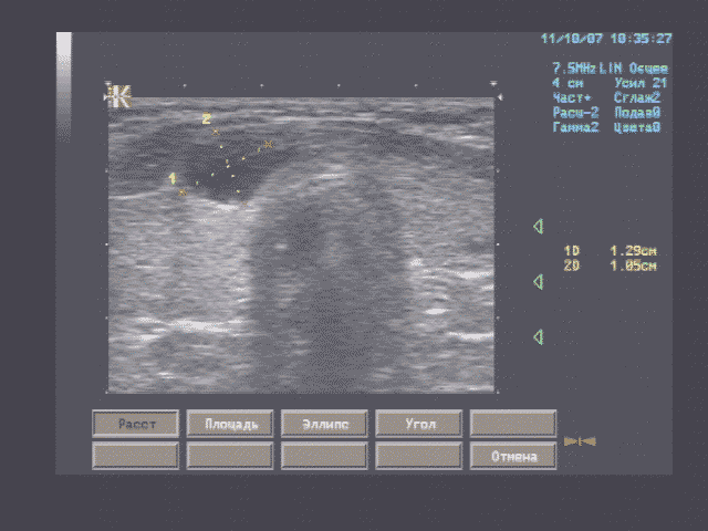 Эхографические признаки кисты перешейка (по структуре фолликулярной), кистозно расширенных фолликулов левой доли щитовидной железы.