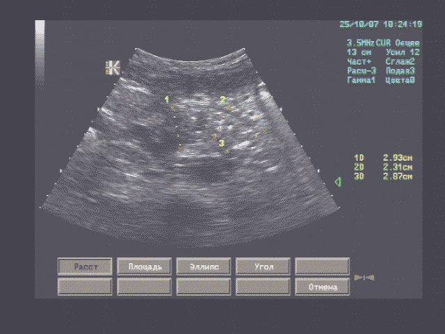 Поджелудочная железа обычной формы, с чёткими волнистыми контурами, толщина головки 29 мм., тела - 23 мм., хвоста – 27 мм., эхоструктура изоэхогенная, неоднородная за счет множества гиперэхогенных включение 1 – 4 мм., не дающих акустических теней, рисунок зернистости относительно четкий, главный панкреатический проток не расширен. Поджелудочная железа обычной формы, с чёткими волнистыми контурами, толщина головки 29 мм., тела - 23 мм., хвоста – 27 мм., эхоструктура изоэхогенная, неоднородная за счет множества гиперэхогенных включение 1 – 4 мм., не дающих акустических теней, рисунок зернистости относительно четкий, главный панкреатический проток не расширен.