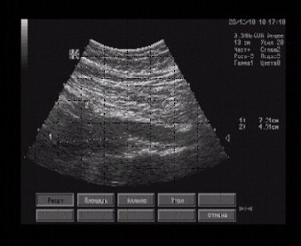 Эхографические признаки гипоэхогенного образования в проекции брюшного отдела аорты