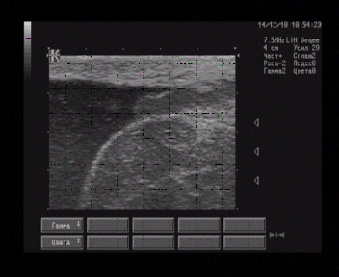 Эхографические признаки неоплазмы левого яичка, левостороннего гидроцеле.