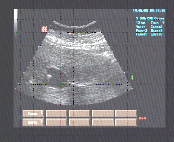 Эхографические признаки наличия плотной структуры в проекции слизистой жёлчного пузыря, напоминающей строением фиброзный полип. Рекомендован ультразвуковой контроль.