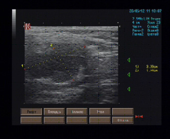 Эхографические признаки солидного образования вблизи верхнего полюса левой слюной железы