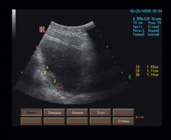 Эхографические признаки многофокусного новообразования мочевого пузыря Эхографические признаки многофокусного новообразования мочевого пузыря