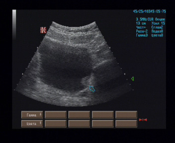 Эхографические признаки многофокусного новообразования мочевого пузыря. Эхографические признаки многофокусного новообразования мочевого пузыря.