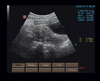 Эхографические признаки интрамуральной миомы передней стенки перешеечного отдела матки Эхографические признаки интрамуральной миомы передней стенки перешеечного отдела матки