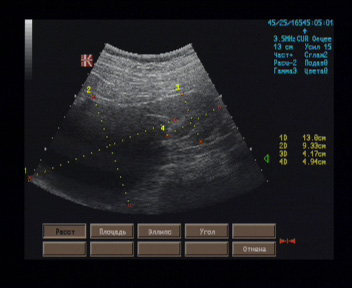 Эхографические признаки гигантской кисты правой почки, синусной кисты левой почки