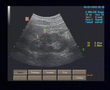 Эхографические признаки локальной дисплазии паренхимы левой почки. Рекомендована компьютерная томография левой почки с целью исключения новообразования.