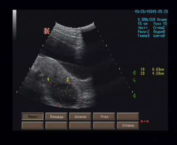 Эхографические признаки жидкостного образования позади матки слева.