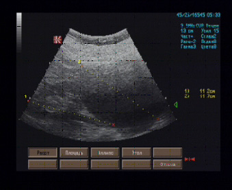 Эхографические признаки гигантской кисты нижнего сегмента левой почки.