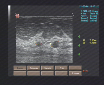 Эхографические признаки кист молочных желёз.