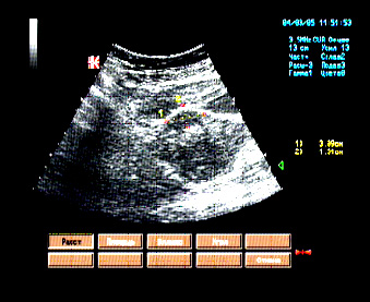 Эхографические признаки интерстициально-субсерозной миомы тела матки. Эхографические признаки интерстициально-субсерозной миомы тела матки.
