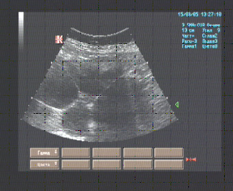 Правая половина живота от правой доли печени до гребня подвздошной кости занята многокамерным жидкостным образованием размерами Правая половина живота от правой доли печени до гребня подвздошной кости занята многокамерным жидкостным образованием размерами