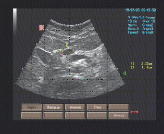 Эхографические признаки простой кисты головки поджелудочной железы. Эхографические признаки простой кисты головки поджелудочной железы.