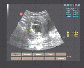 Эхографические признаки ретрохориальной гематомы при маточной беременности сроком 8 недель Эхографические признаки ретрохориальной гематомы при маточной беременности сроком 8 недель