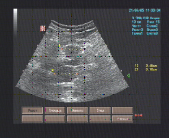 Эхографические признаки диффузных изменений в паренхиме печени и селезёнки, гепатоспленомегалии, гиперплазии Эхографические признаки диффузных изменений в паренхиме печени и селезёнки, гепатоспленомегалии, гиперплазии