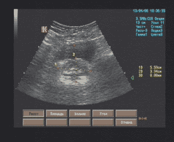 Эхографические признаки гиперплазии предстательной железы, хронического простатита. Эхографические признаки гиперплазии предстательной железы, хронического простатита.