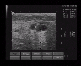 Эхографические признаки фибрознокистозной мастопатии с пристеночной тканью в одной из кист (дифференцировать с секретом). Эхографические признаки фибрознокистозной мастопатии с пристеночной тканью в одной из кист (дифференцировать с секретом).