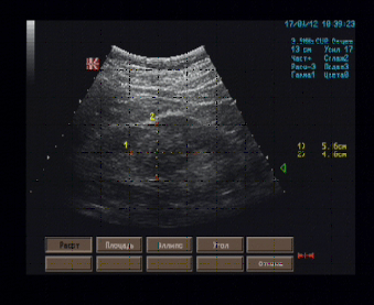 Эхографические признаки солидного образования среднего сегмента правой почки (дифференцировать колонку Бертина от опухоли почечного синуса).