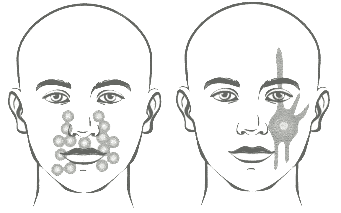 Варианты распространения боли при невралгии тройничного нерва Варианты распространения боли при невралгии тройничного нерва