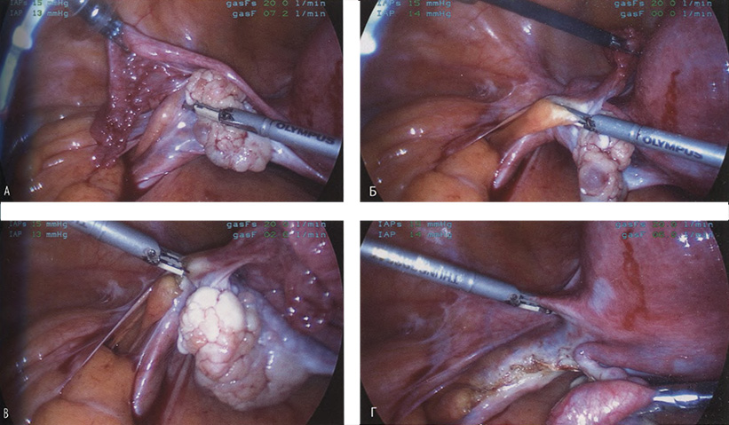 Представлен момент пересечения воронко-тазовой связки Представлен момент пересечения воронко-тазовой связки