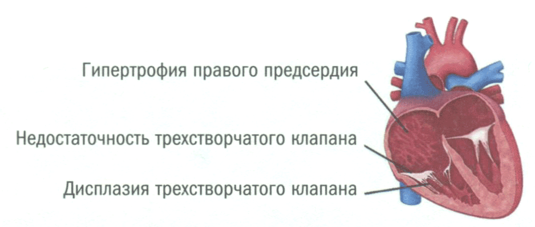 Гипертрофия правого предсердия