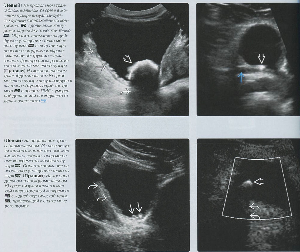 Конкременты мочевого пузыря. УЗИ мочевого пузыря