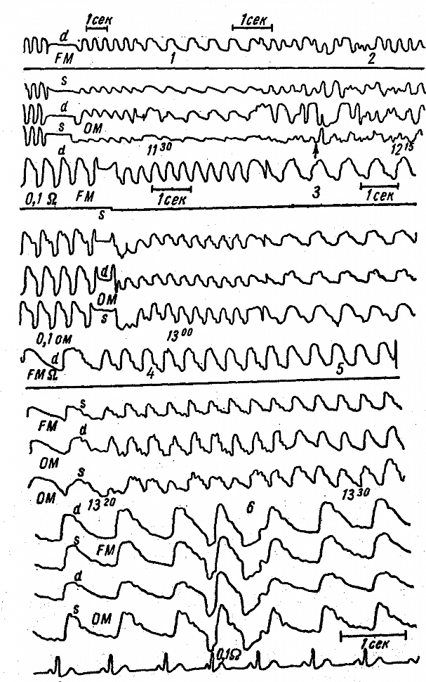 Динамика РЭГ больного 3. с гипоплазией и аномальным отхождением левой позвоночной артерии