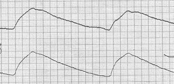 Рис. 31. Изменения РЭГ при склеротической стадии артериальной гипертензии