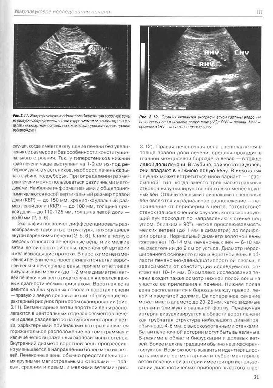 Эхографическое изображение бифуркации воротной вены