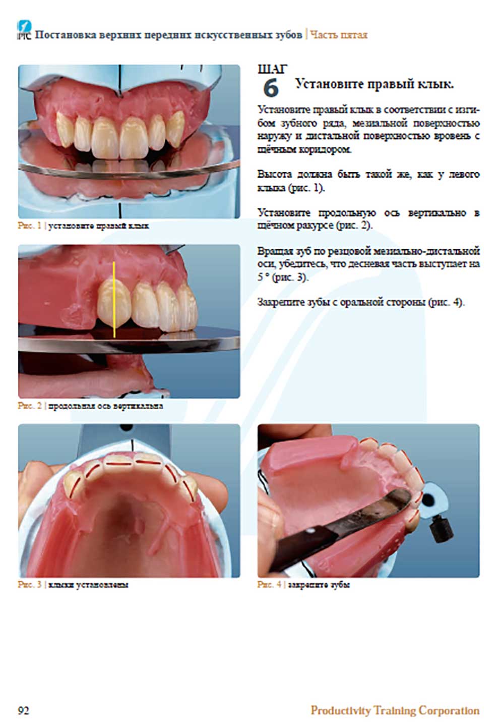 Постановка верхних передних искусственных зубов