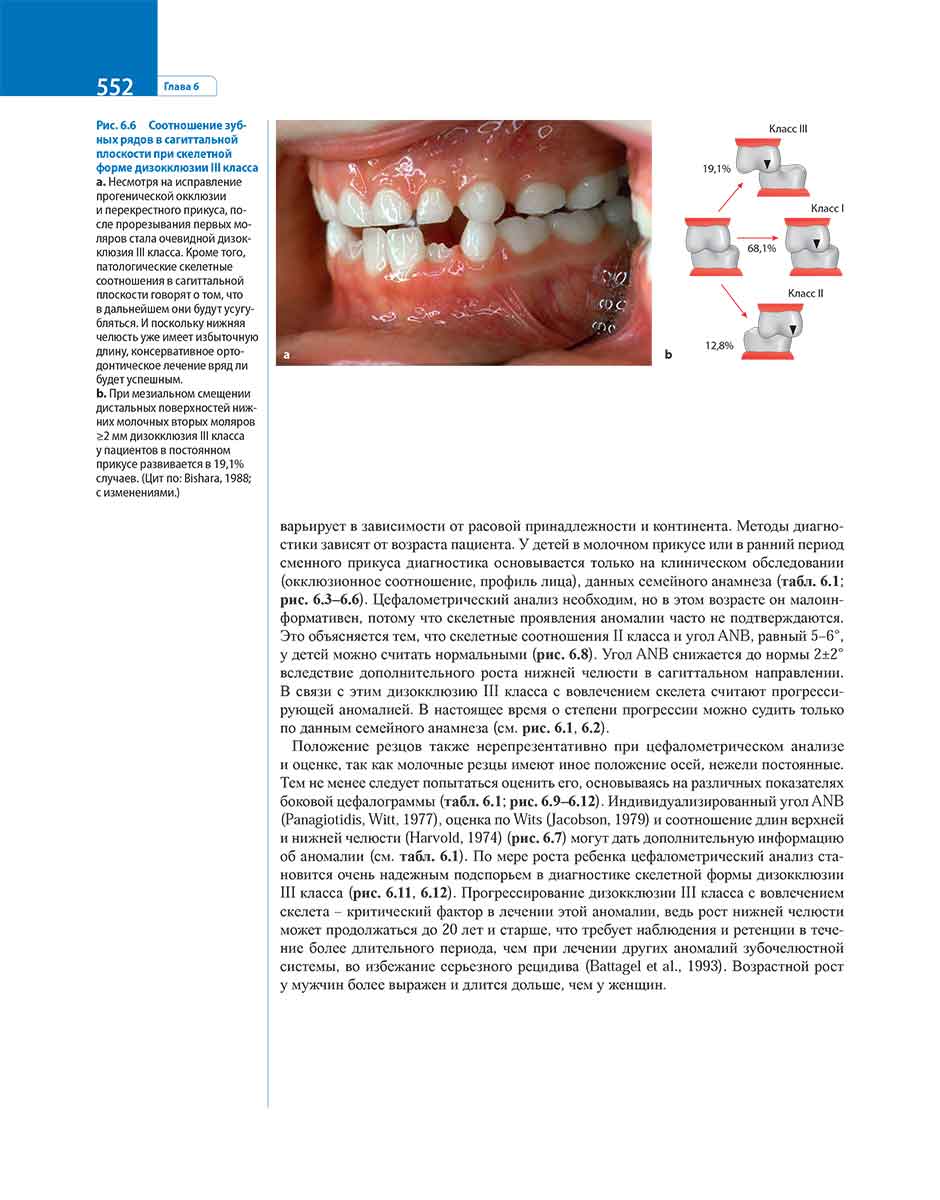 Рис. 6.6 Соотношение зубных рядов в сагиттальной плоскости при скелетной форме дизокклюзии III класса