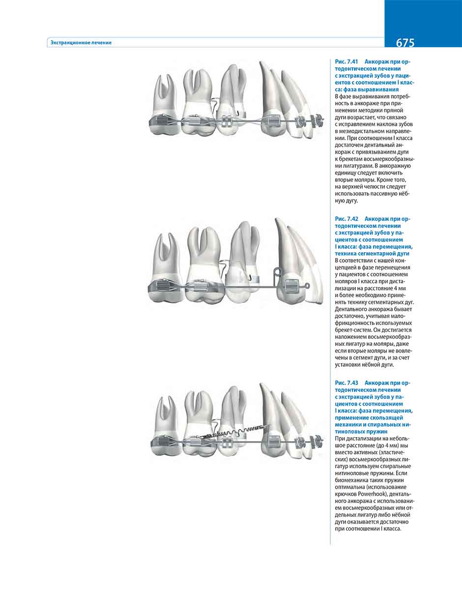 Рис. 7.41 Анкораж при ортодонтическом лечении с экстракцией зубов у пациентов с соотношением I класса: фаза выравнивания