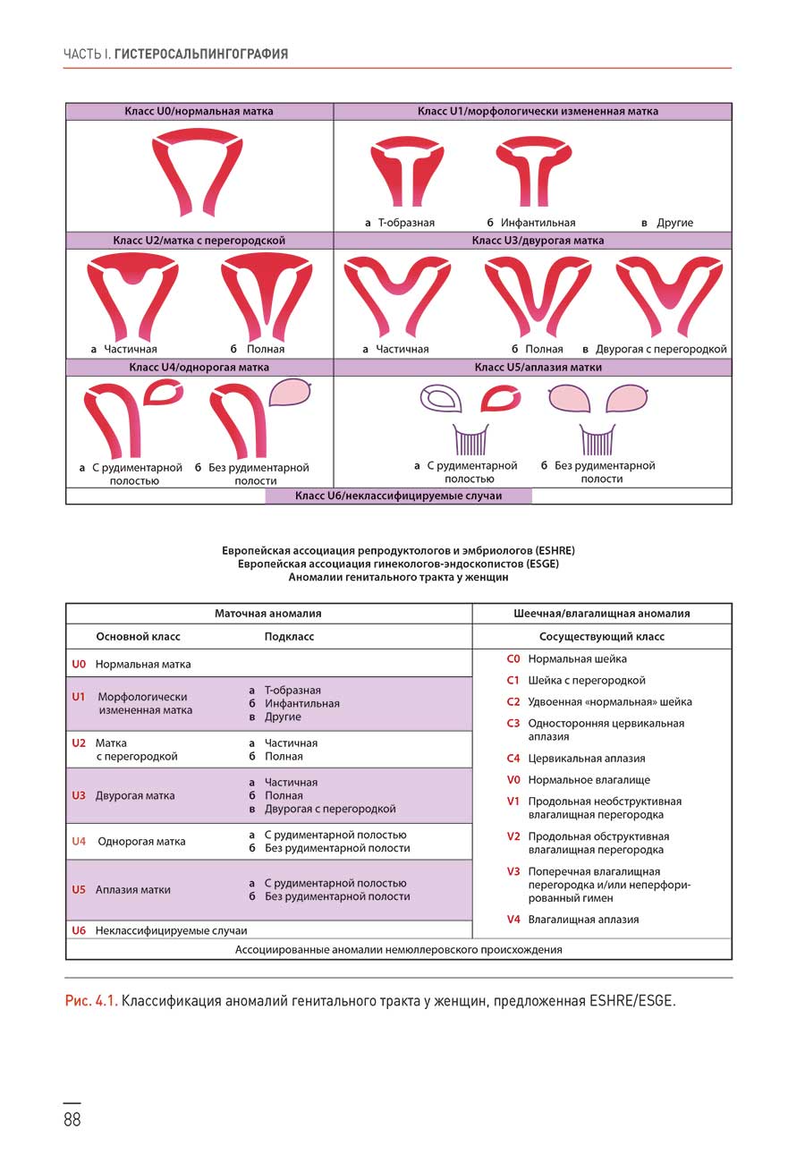Рис. 4.1. Классификация аномалий генитального тракта у женщин, предложенная