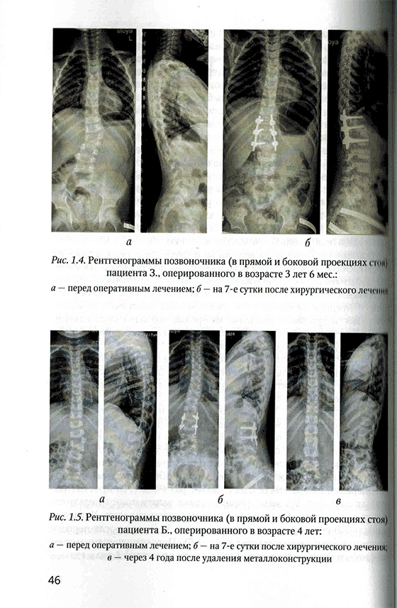 Рентгенограммы позвоночника