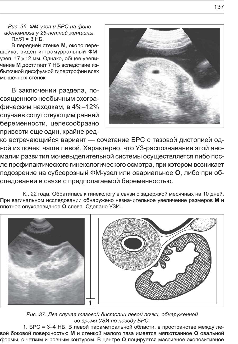 Рис. 37. Два случая тазовой дистопии левой почки, обнаруженной во время УЗИ по поводу БРС.