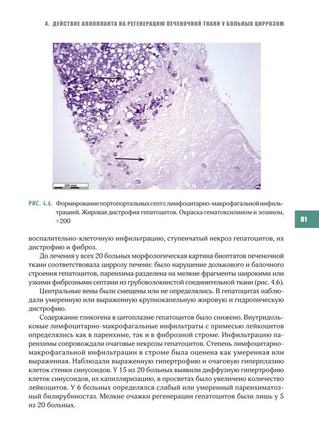 Формирование портопортальных септслимфоцитарно-макрофагальной инфильтрацией. Жировая дистрофия гепатоцитов.