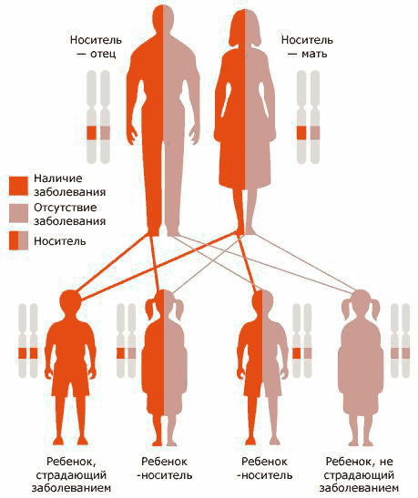 Дефектный ген муковисцидоза широко распространен — каждый 25-й житель Северной Европы