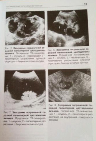 Пример страницы из книги "Эхография органов малого таза у женщин. Пограничные опухоли, рак и редкие опухоли яичников" - Демидов В. Н.