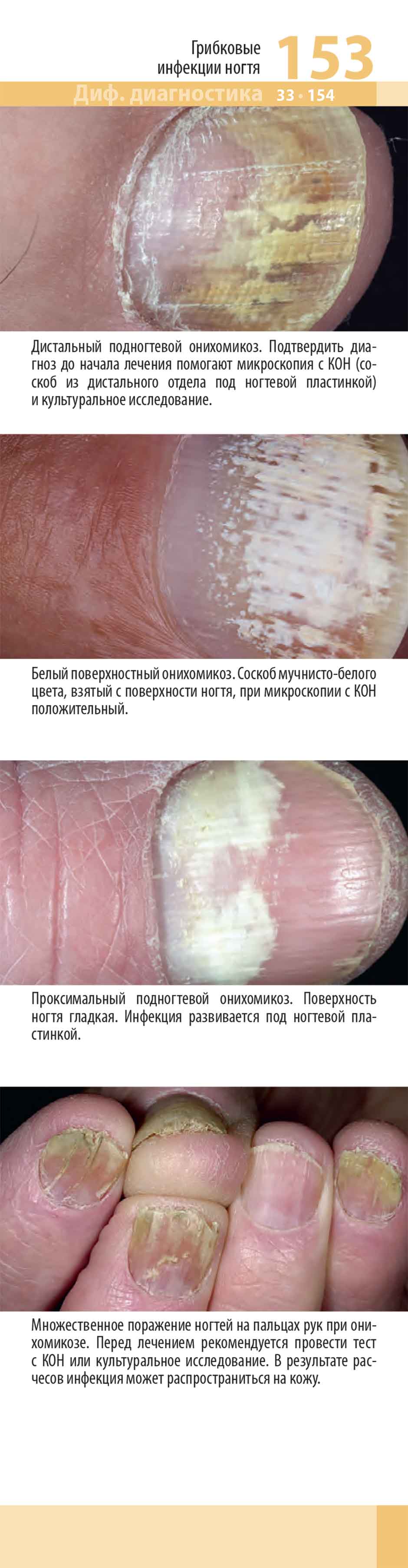 Грибковые инфекции ногтя