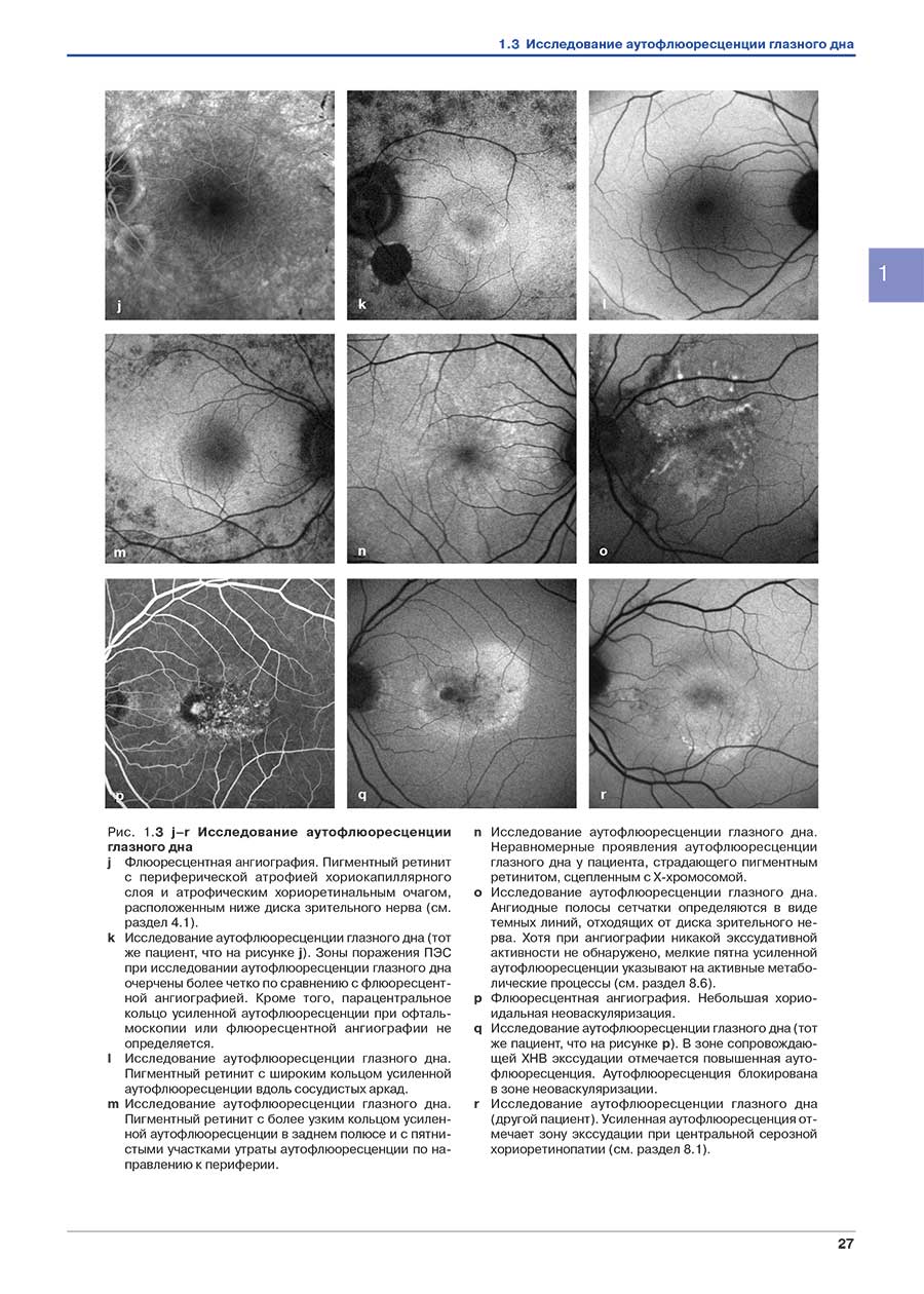 Рис. 1.3 j-r Исследование аутофлюоресценции глазного дна