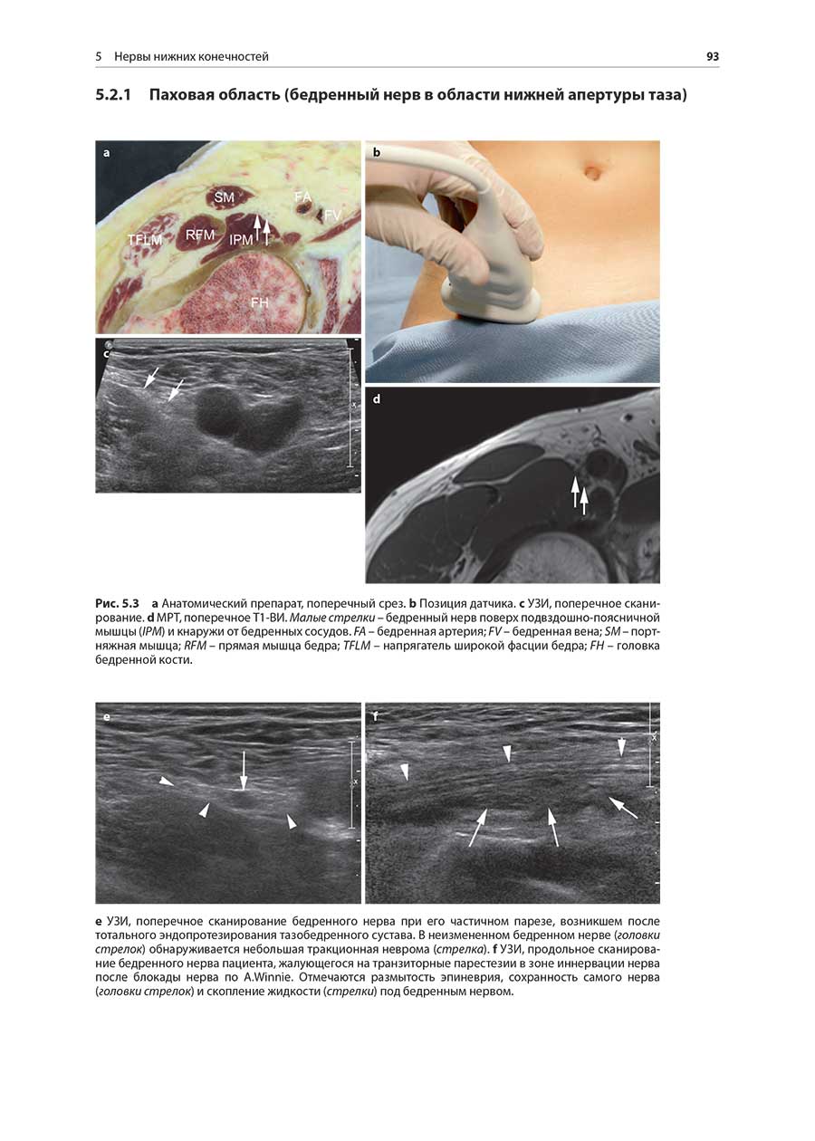 УЗИ, поперечное сканирование бедренного нерва при его частичном парезе