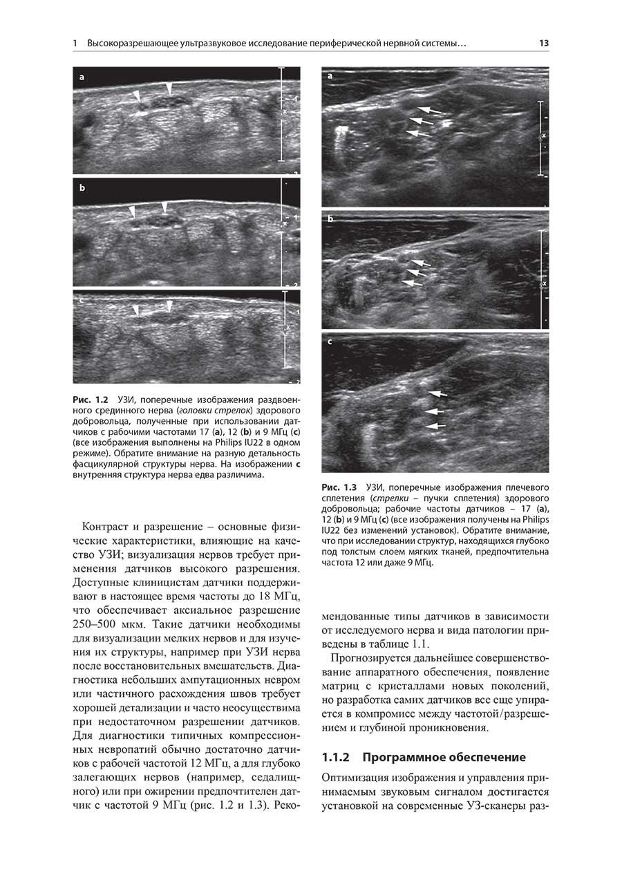 Рис. 1.2 УЗИ, поперечные изображения раздвоенного срединного нерва (головки стрелок) здорового