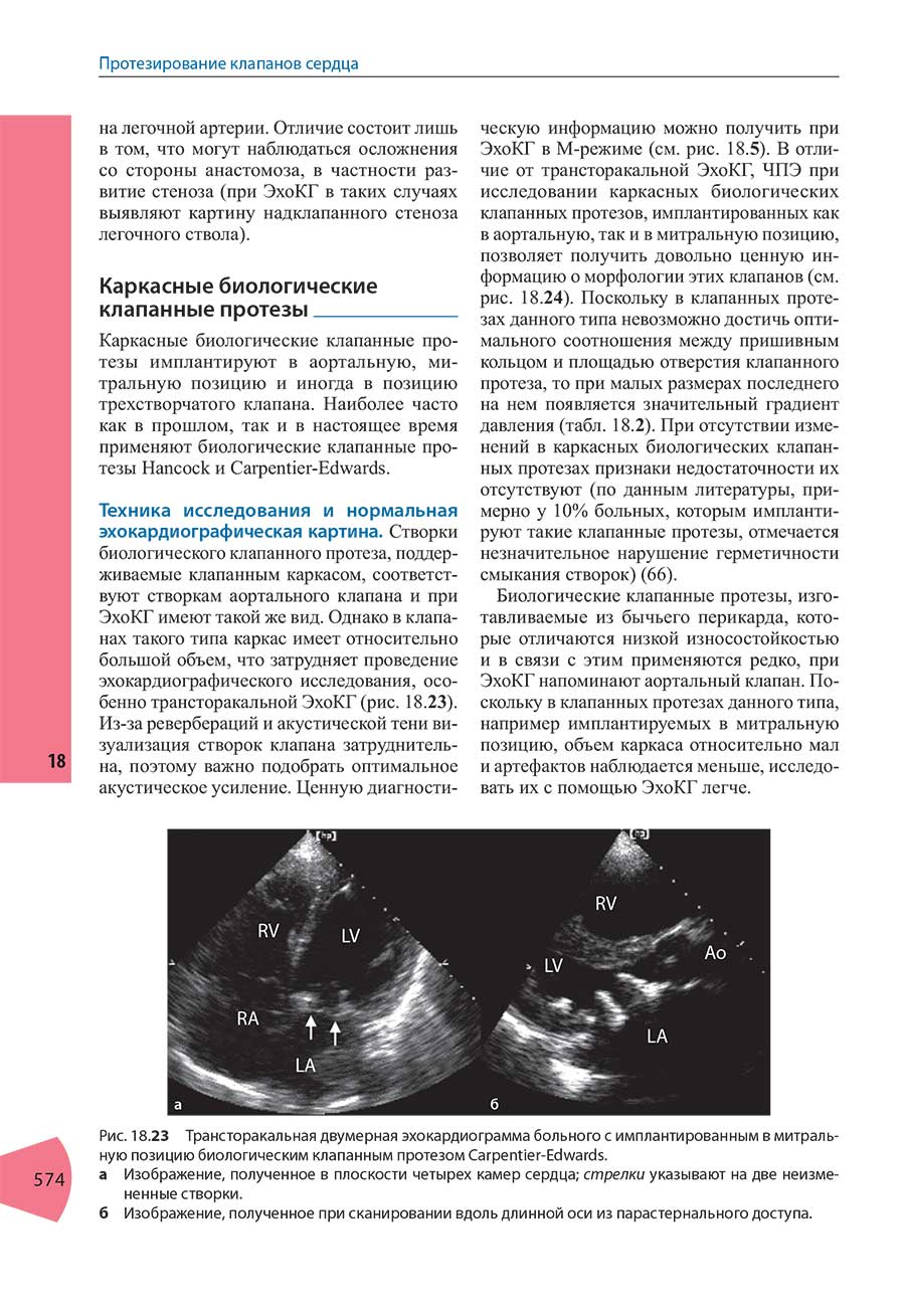 Рис. 18.23 Трансторакальная двумерная эхокардиограмма больного с имплантированным в митральную позицию биологическим клапанным протезом Carpentier-Edwards.