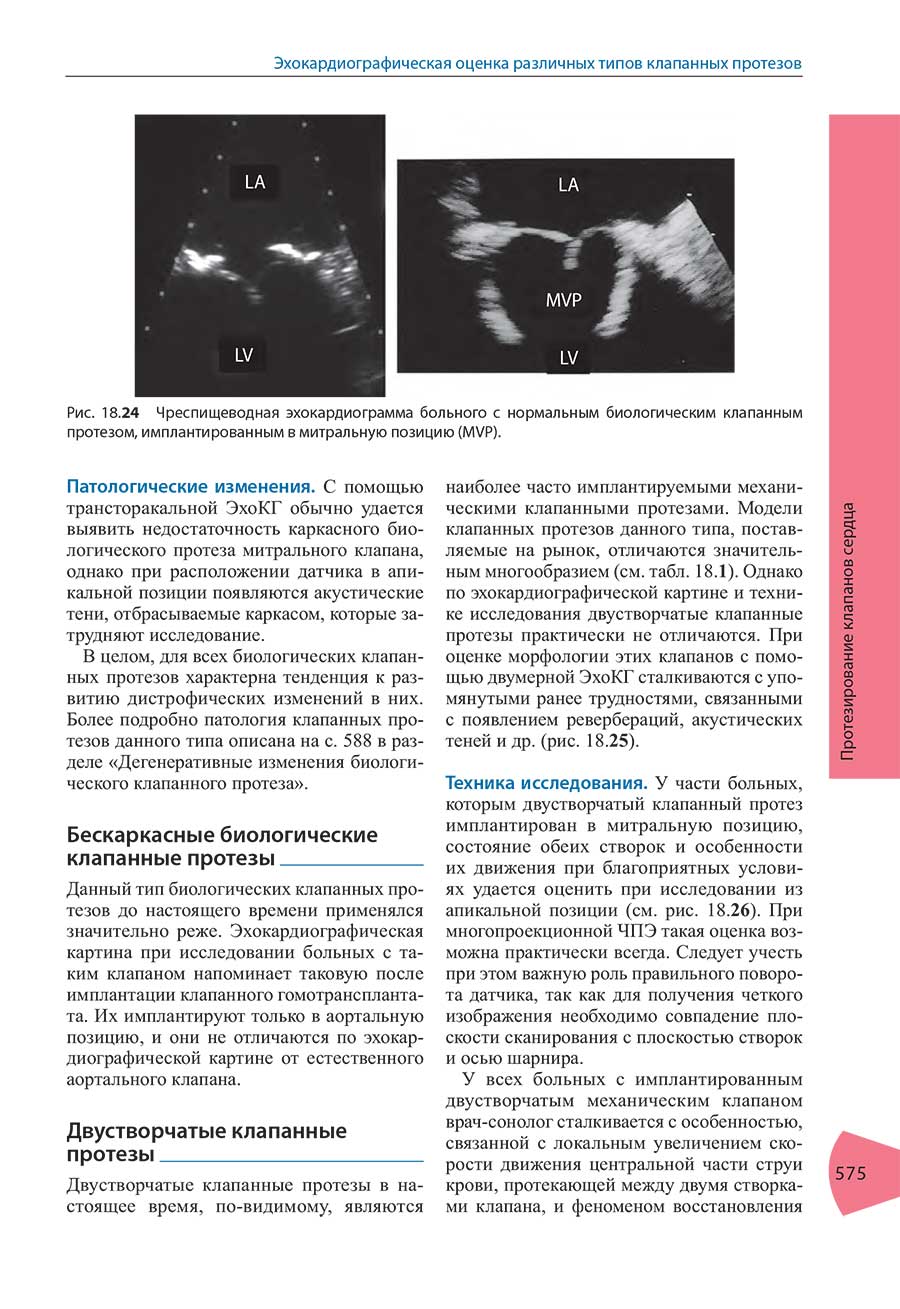 Рис. 18.24 Чреспищеводная эхокардиограмма больного с нормальным биологическим клапанным протезом, имплантированным в митральную позицию (MVP).