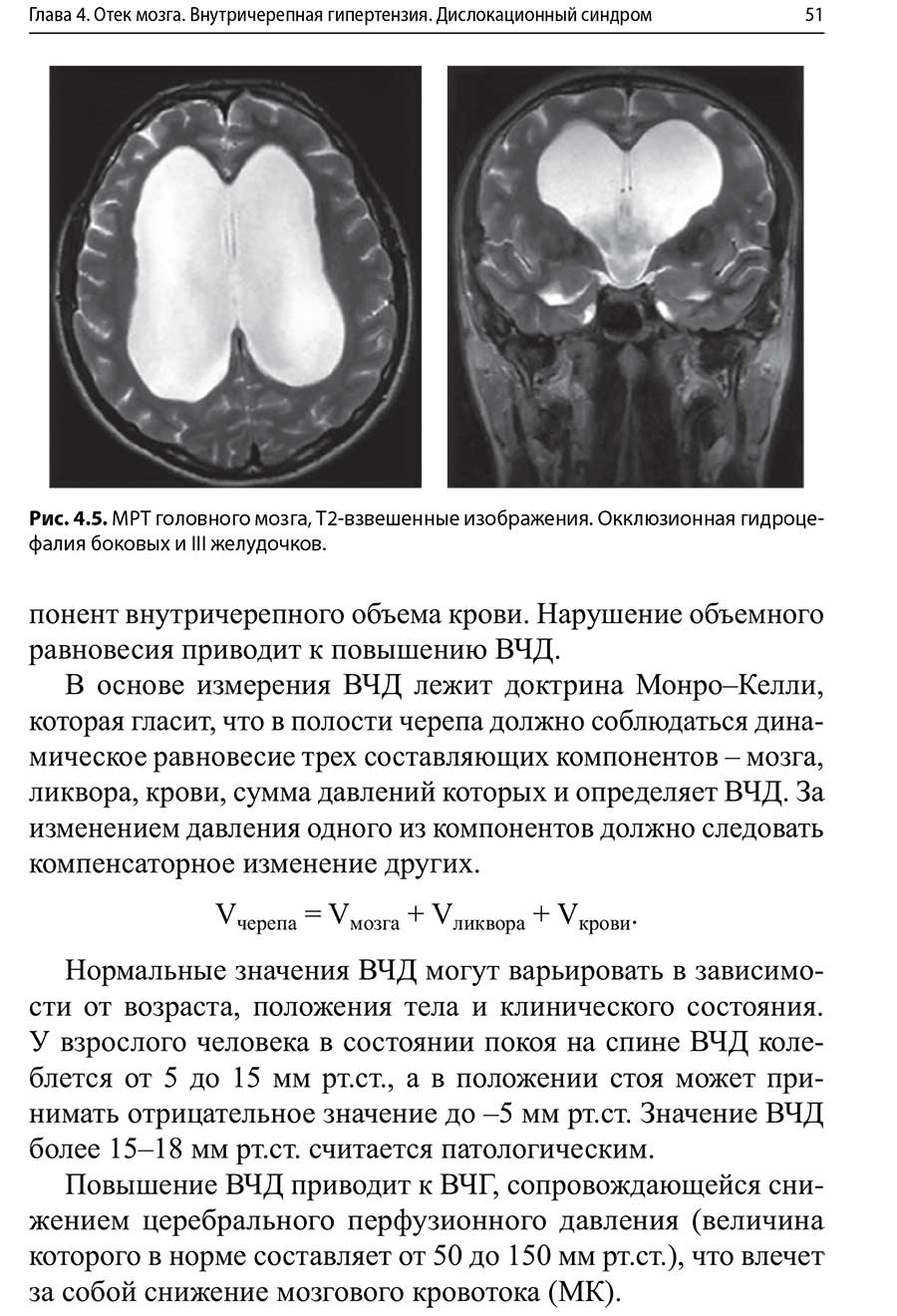 MPT головного мозга